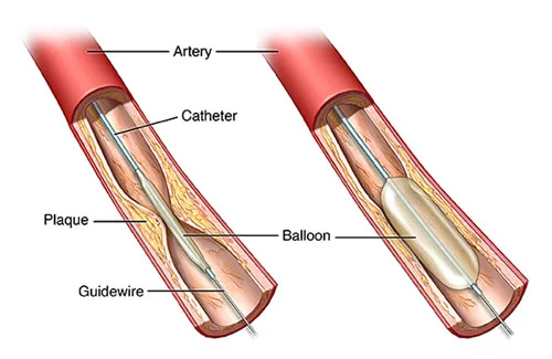 coronary-angioplasty