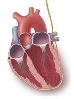 heart-failure-management