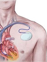pacemaker-implantation